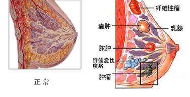 高新區的中醫腫瘤醫院_趙春天:乳腺瘤復發轉移概率高嗎?