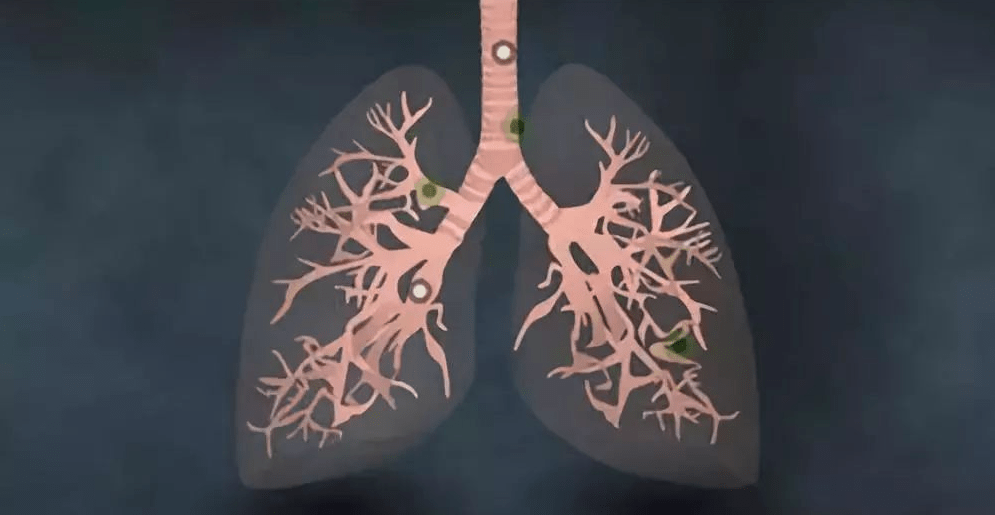 《自然》子刊：为什么有些人不抽烟也会得肺癌？