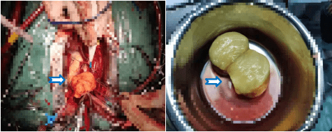 赵冬|发病率百万分之一！天津专家在男子心脏里取出乒乓球大小肿瘤！