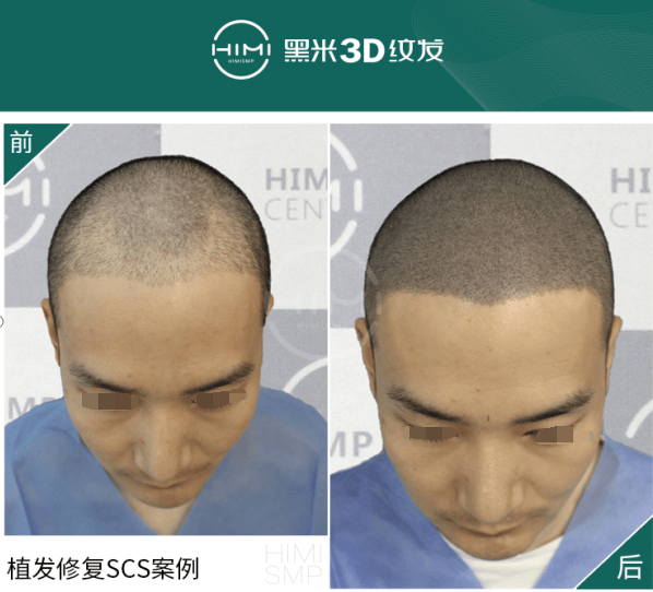 人群黑米3D纹发：纹发老师告诉你，哪些人群适合纹发？