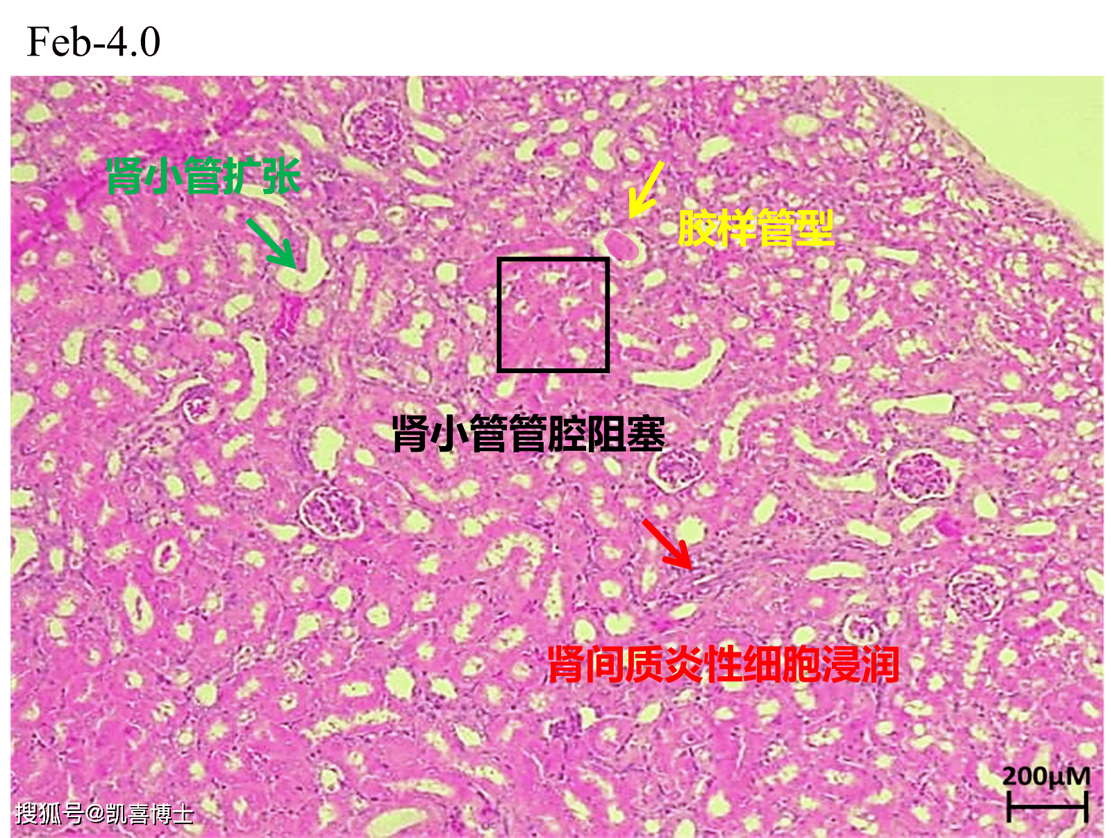 剂量组的肾脏切片中,可以看到:部分肾间质炎性细胞浸润,部分肾小管