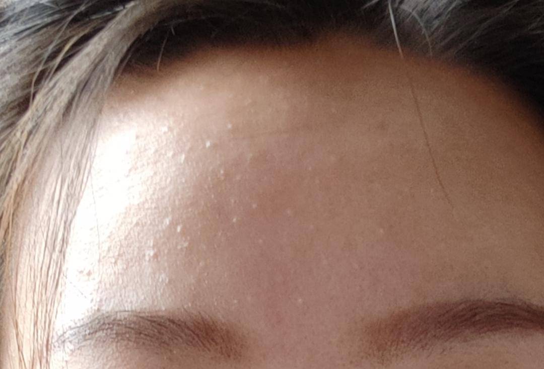 寻香师额头闭口1招简单搞定