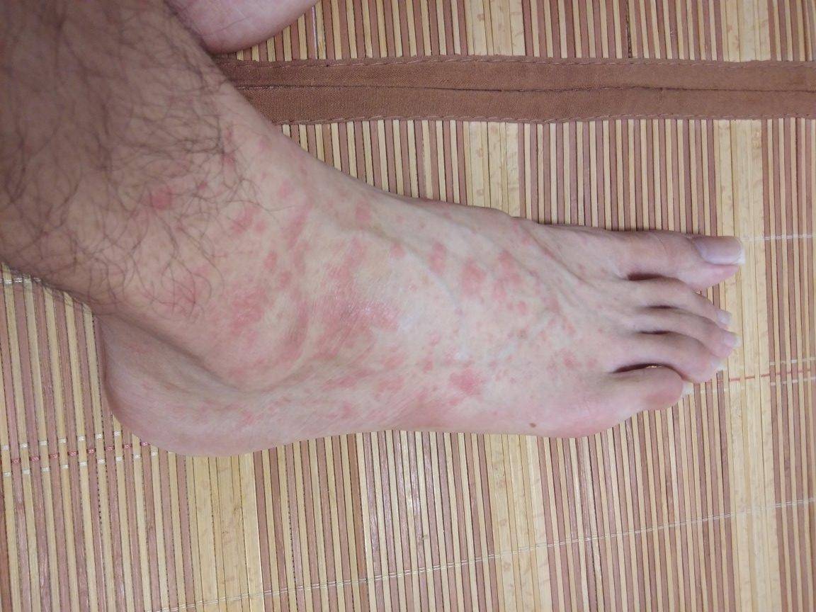 长春肤康医院浅谈:为什么荨麻疹在晚间特别容易发作?