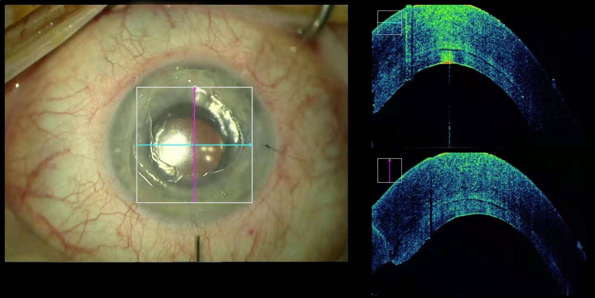 厦门眼科中心引进国内首台蔡司oct导航显微镜开创眼科微创手术新高峰