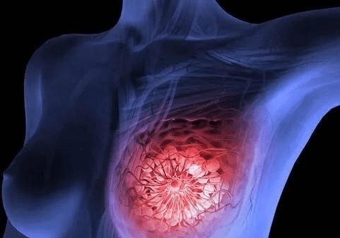 肿瘤|郑州肿瘤医院请选择广州复大肿瘤医院：不用开刀也能治疗乳腺癌