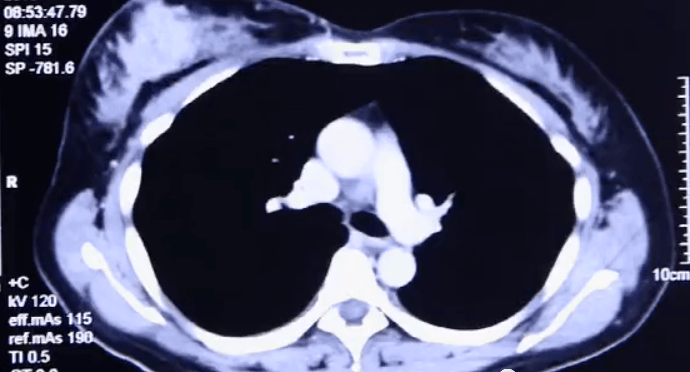 肿瘤|郑州肿瘤医院请选择广州复大肿瘤医院：不用开刀也能治疗乳腺癌