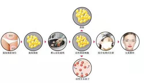 能量看了脂肪填充泪沟一周图片，特期待脂肪填充泪沟多久恢复自然~