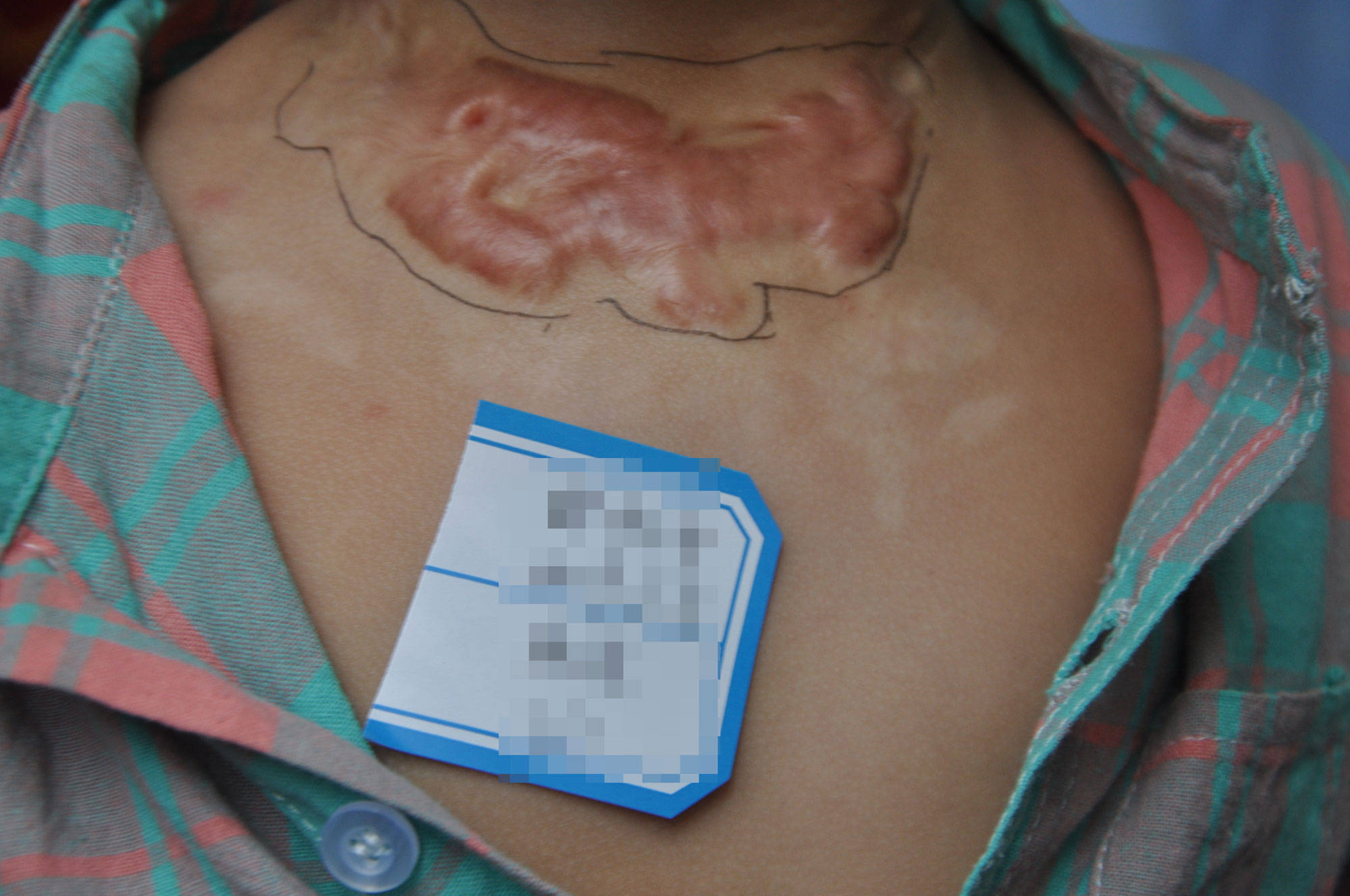 郑州市第二中医院 烫伤后都会留疤吗 治疗