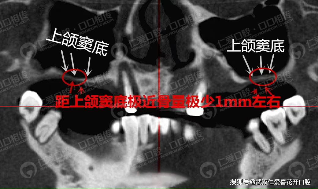 牙槽骨萎缩▎上颌窦内提升 植骨修复