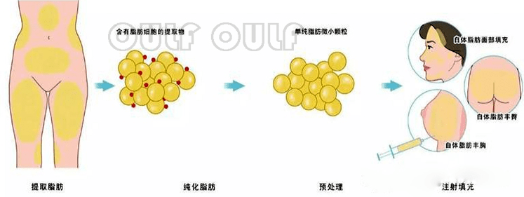 营养自体脂肪全脸填充费用：自体脂肪面部填充大约多少钱？