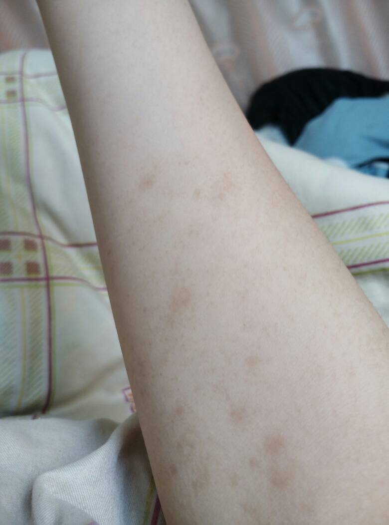 湿疹体质怎么用药恢复比较好