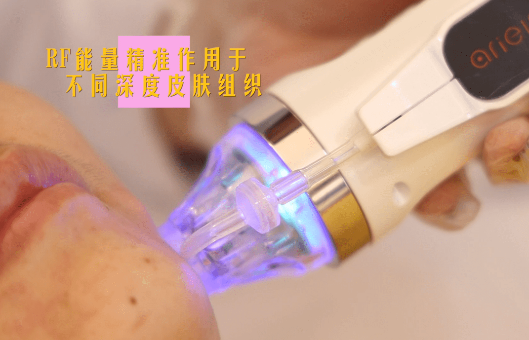 治疗如何改善肌肤暗黄粗糙呢 皮肤粗糙暗黄能做黄金射频微针吗？