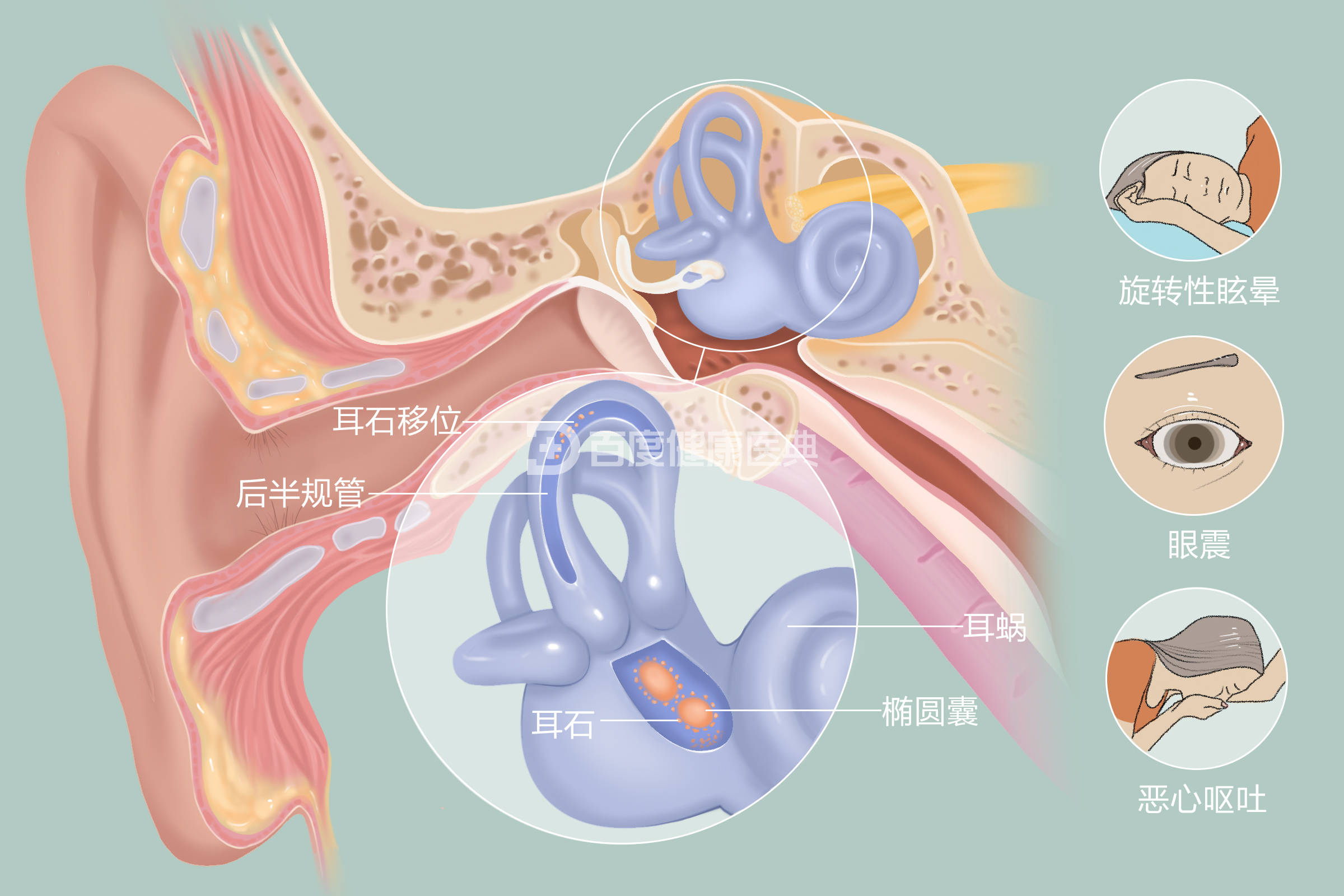 耳石症有什么症状表现图片