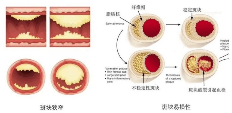 血液|发现颈动脉斑块，怎么办？