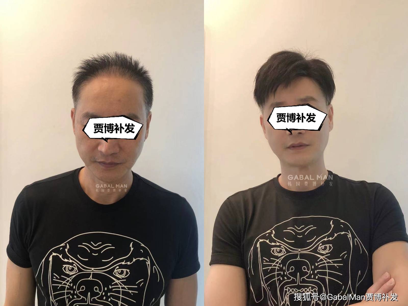 假发写给那些为脱发烦恼的男同胞们