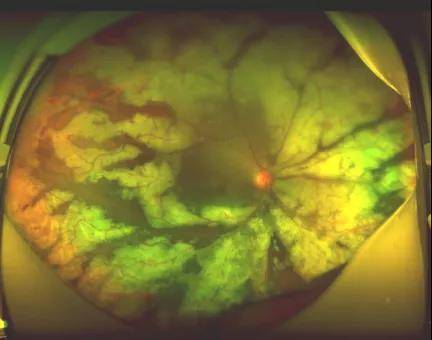 王海燕|莫要谈“艾”色变，关注艾滋患者的眼健康