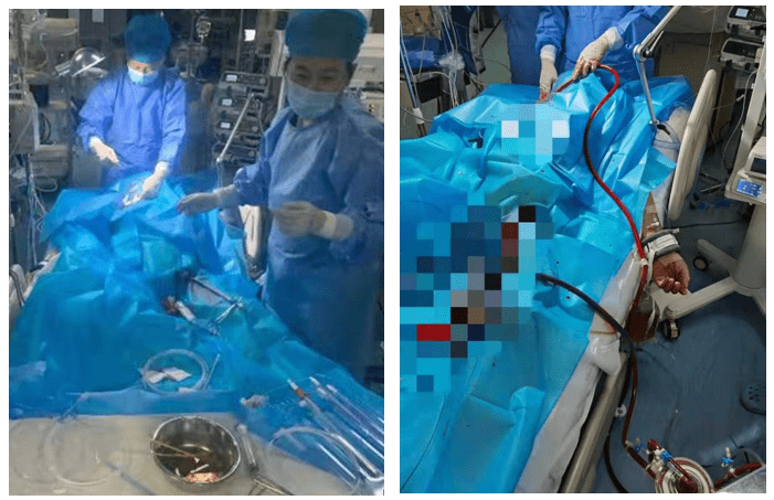成功|成功救治致命出血热！西安交大一附院东院区成功开展首例ECMO技术