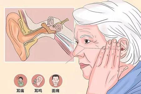 中耳炎最佳治疗方法图片