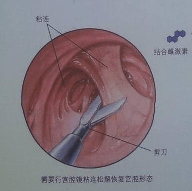 自己检查宫颈的方法图片