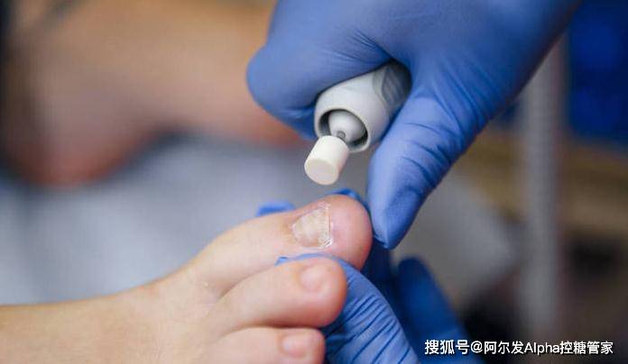 足部|糖友这样进行足部护理，才能跟糖尿病足说“不”