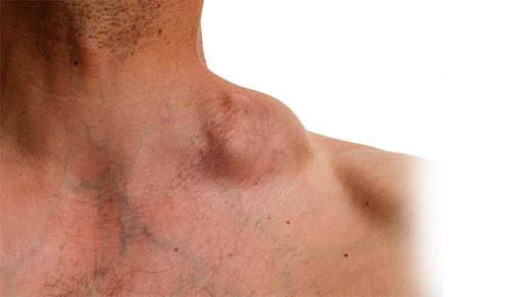 这4种症状或预示淋巴瘤已上身!_治疗_熊顿_霍奇金