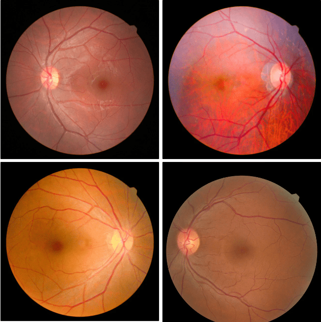 眼底病为什么特别重视