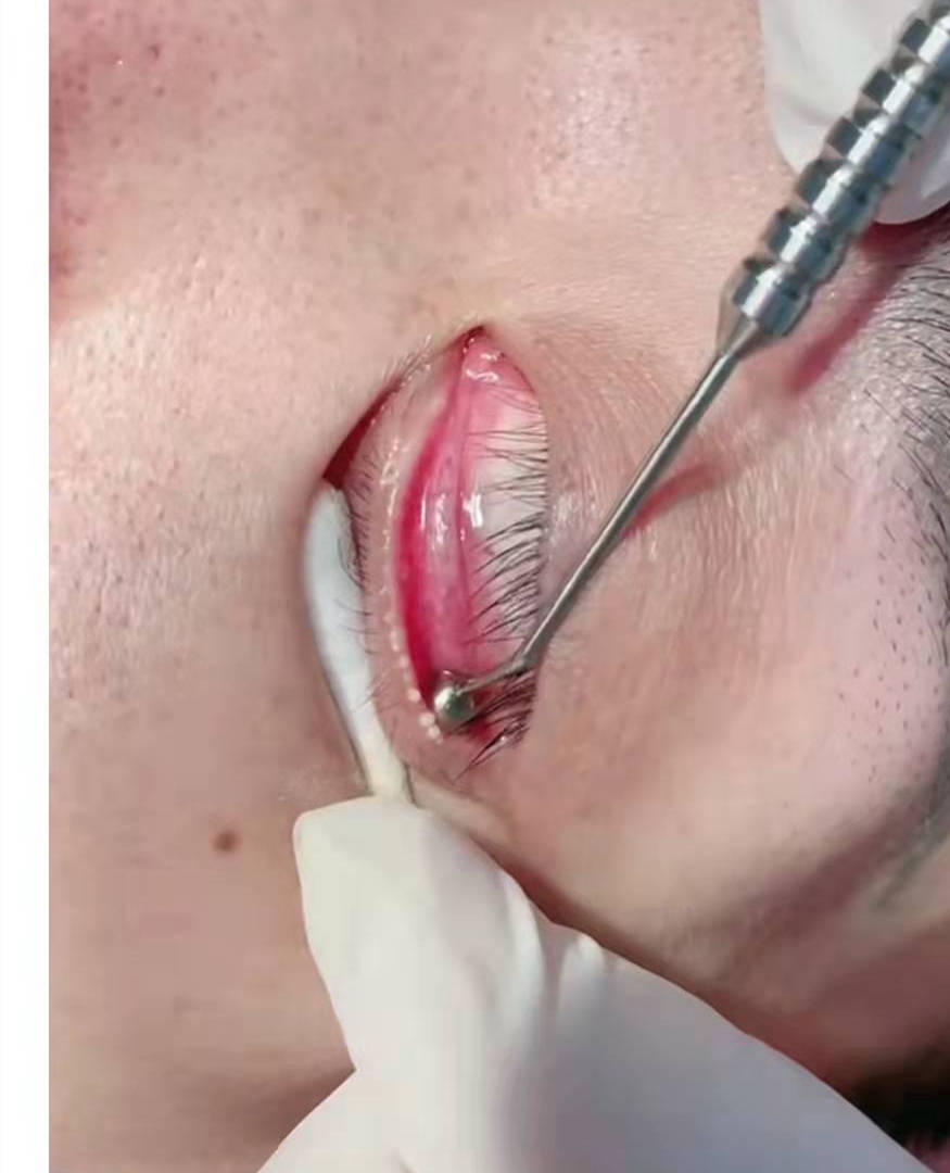 干眼治疗三步法,轻松治好干眼症_患者_按摩_眼睛