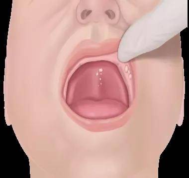新生儿口腔上颚裂图片图片