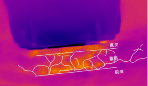 组织细胞听说7d聚拉提对法令纹有效吗，7d聚拉提做后老得加快，真假的！