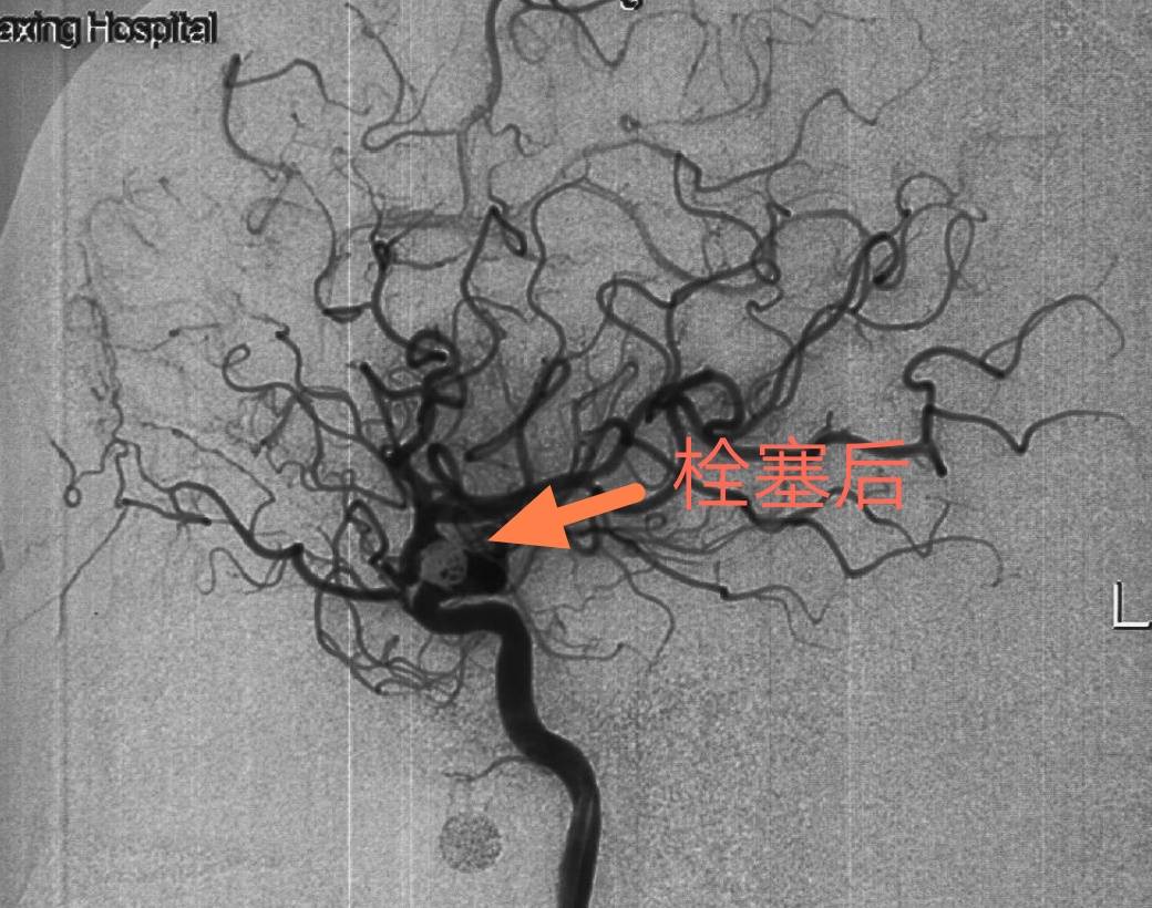 血管|头晕欲裂揪出颅内动脉瘤 医生极限“拆弹”化险为夷