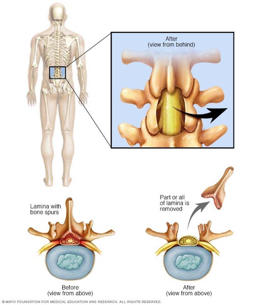 椎管狭窄spinalstenosis顺德康复