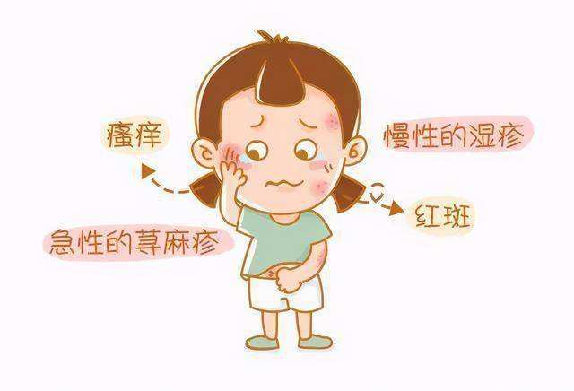 攻略:春季小儿荨麻疹高发,教你缓解的正确方式_风团_皮肤_组胺