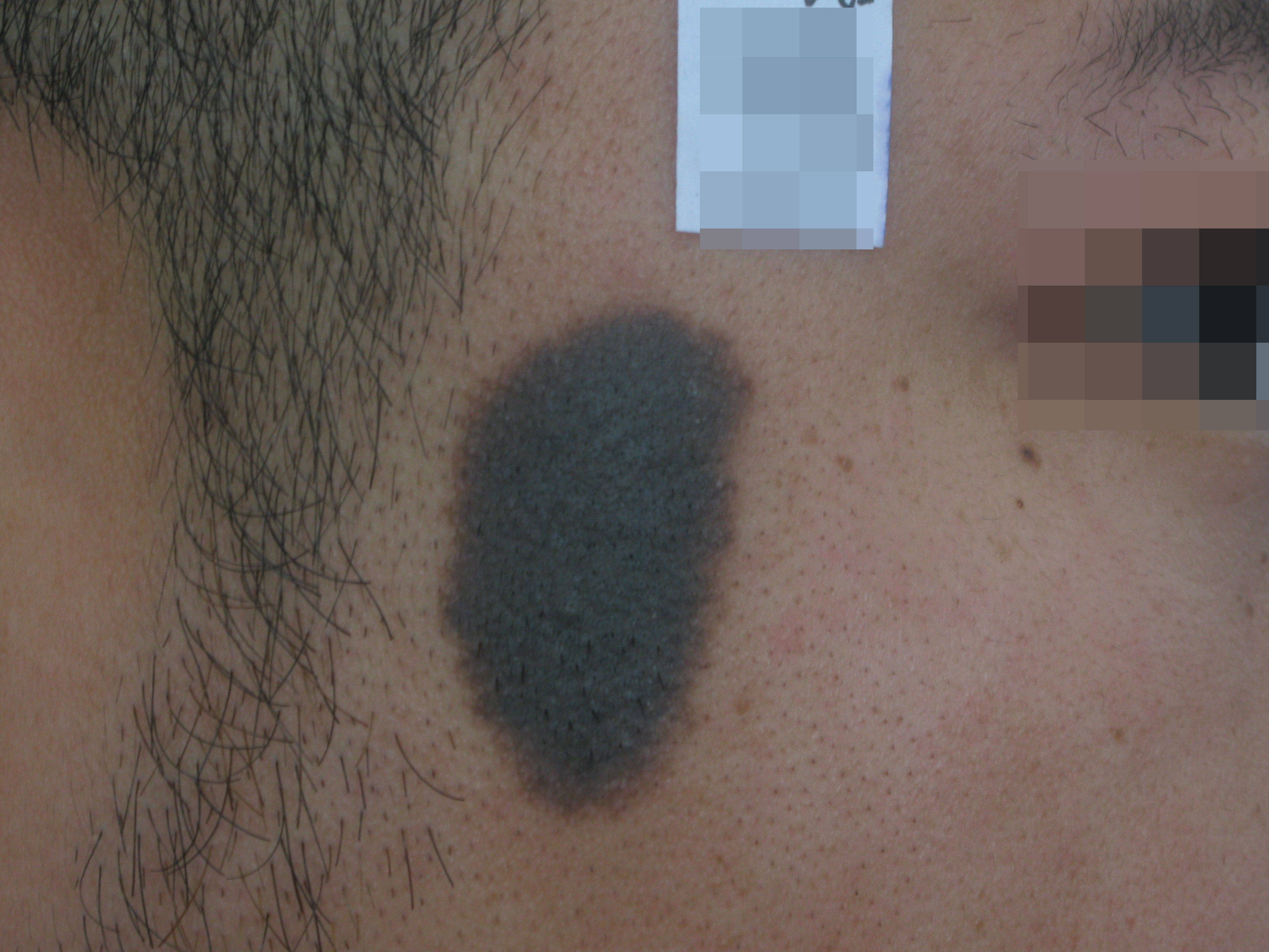 郑州市第二中医院;黑色胎记有哪些症状?该如何修复?_面部_诊疗_进行