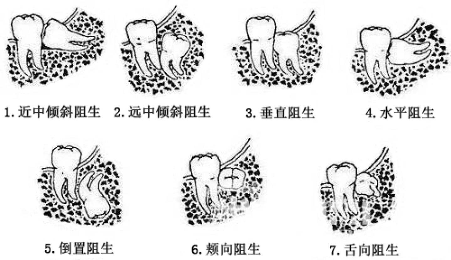 因为拔智齿瘦脸？你在开什么国际玩笑！