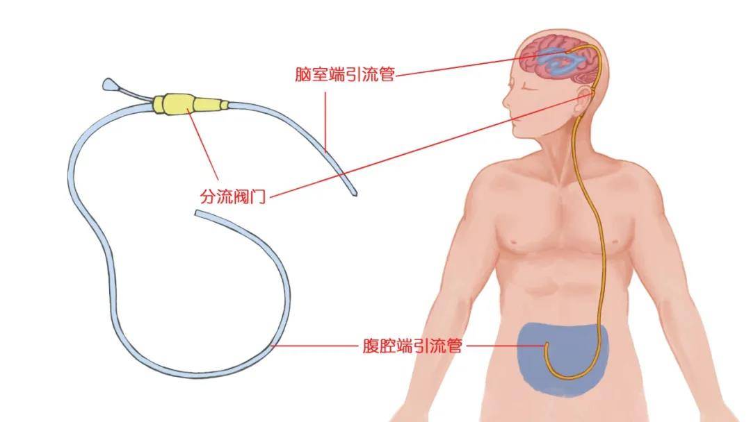 症状|痴呆可逆转 ？医生： 脑子“进水”变痴呆或有救