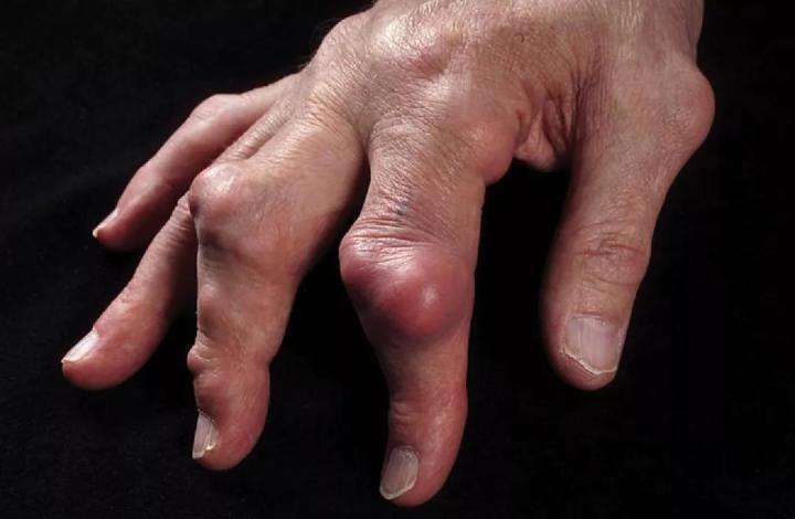 手指结节的症状图片图片