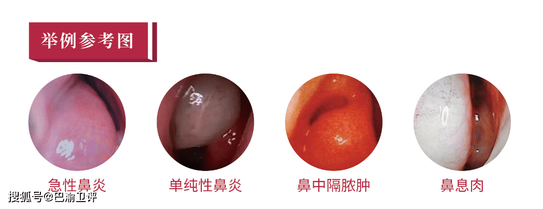 分为急性鼻炎,慢性鼻炎,以及特殊类型鼻炎,如过敏性鼻炎,萎缩性鼻炎