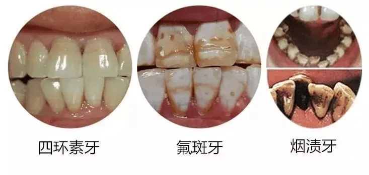 因為乳牙牙釉質較薄,較透明,不易遮蓋牙本質中四環素結合物的顏色