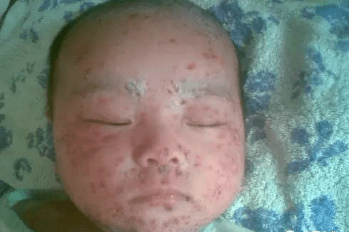 湿疹急疹痱子荨麻疹水痘婴儿痤疮过敏等婴儿疾病的区别与护理