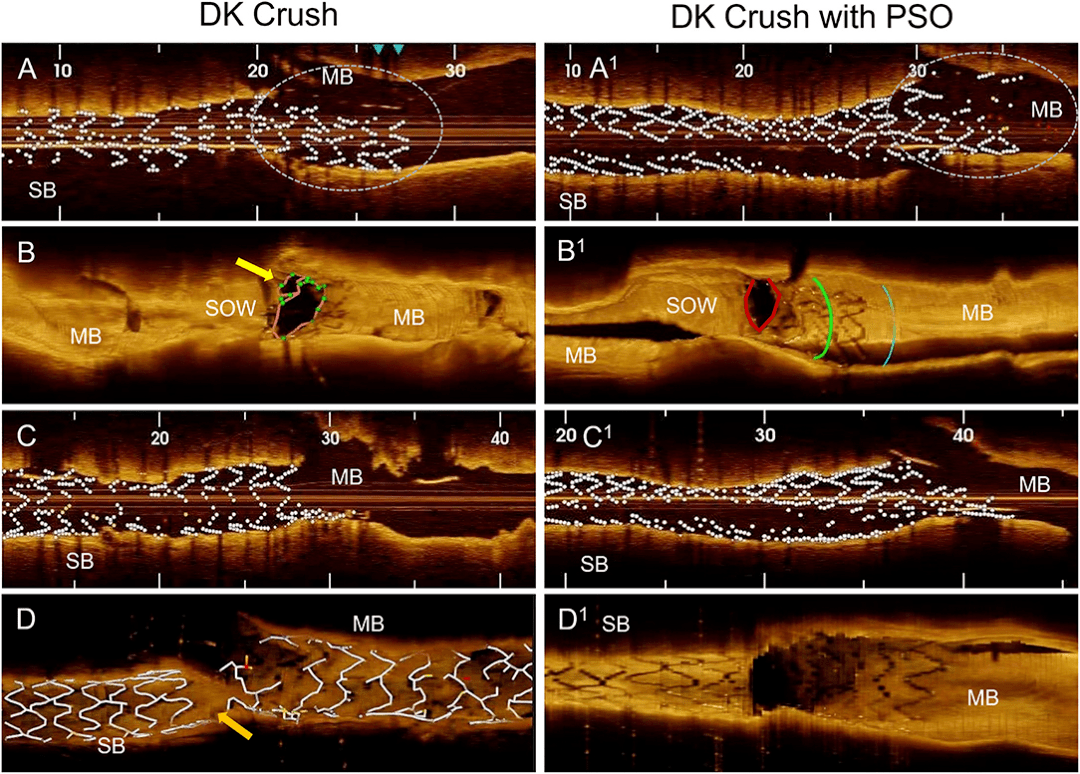 吉林心脏病医院外籍专家合作开展的oct评估dkcrush边支优化技术临床