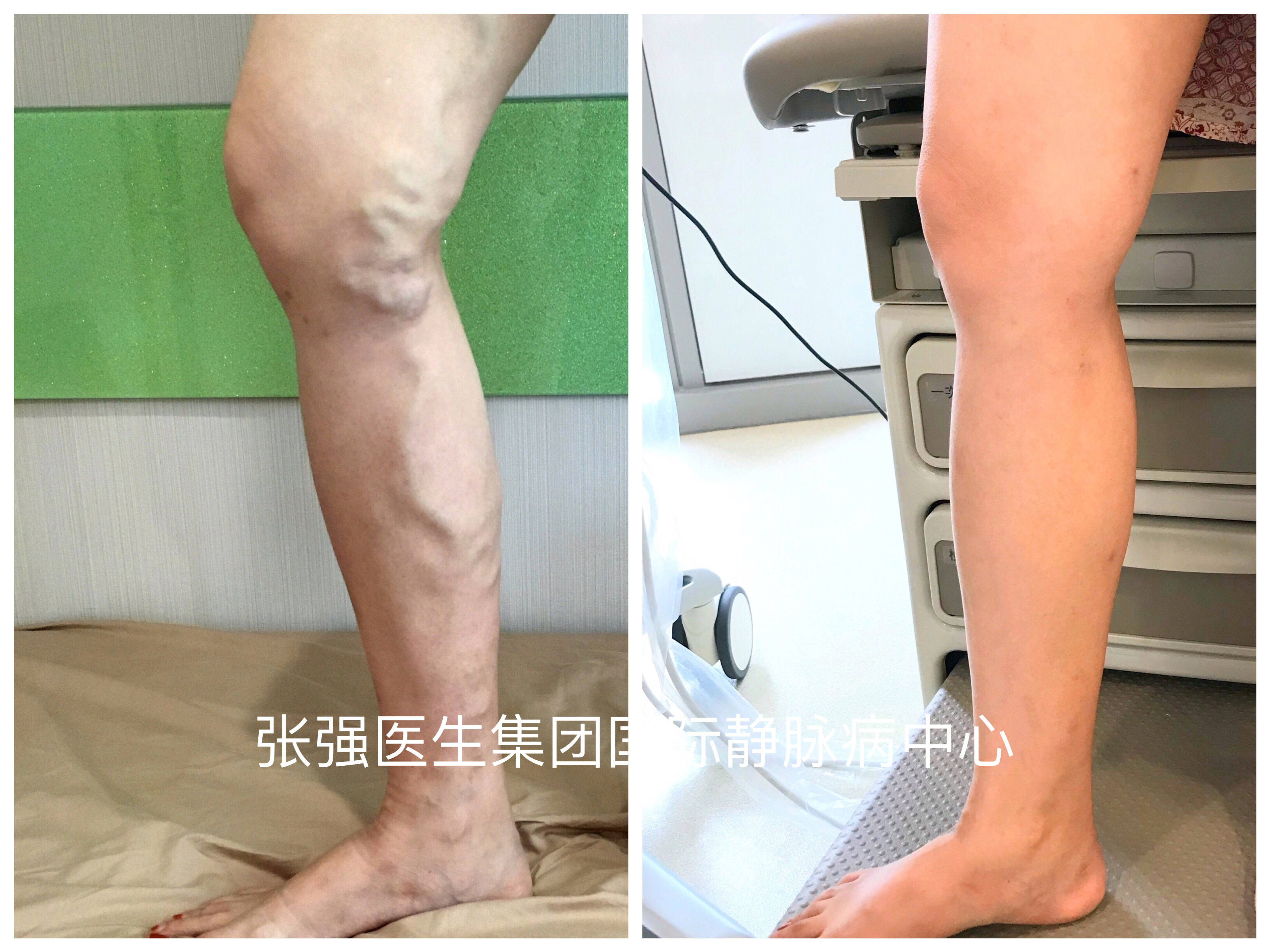 重症静脉曲张的克星chiva治疗背后的医学逻辑