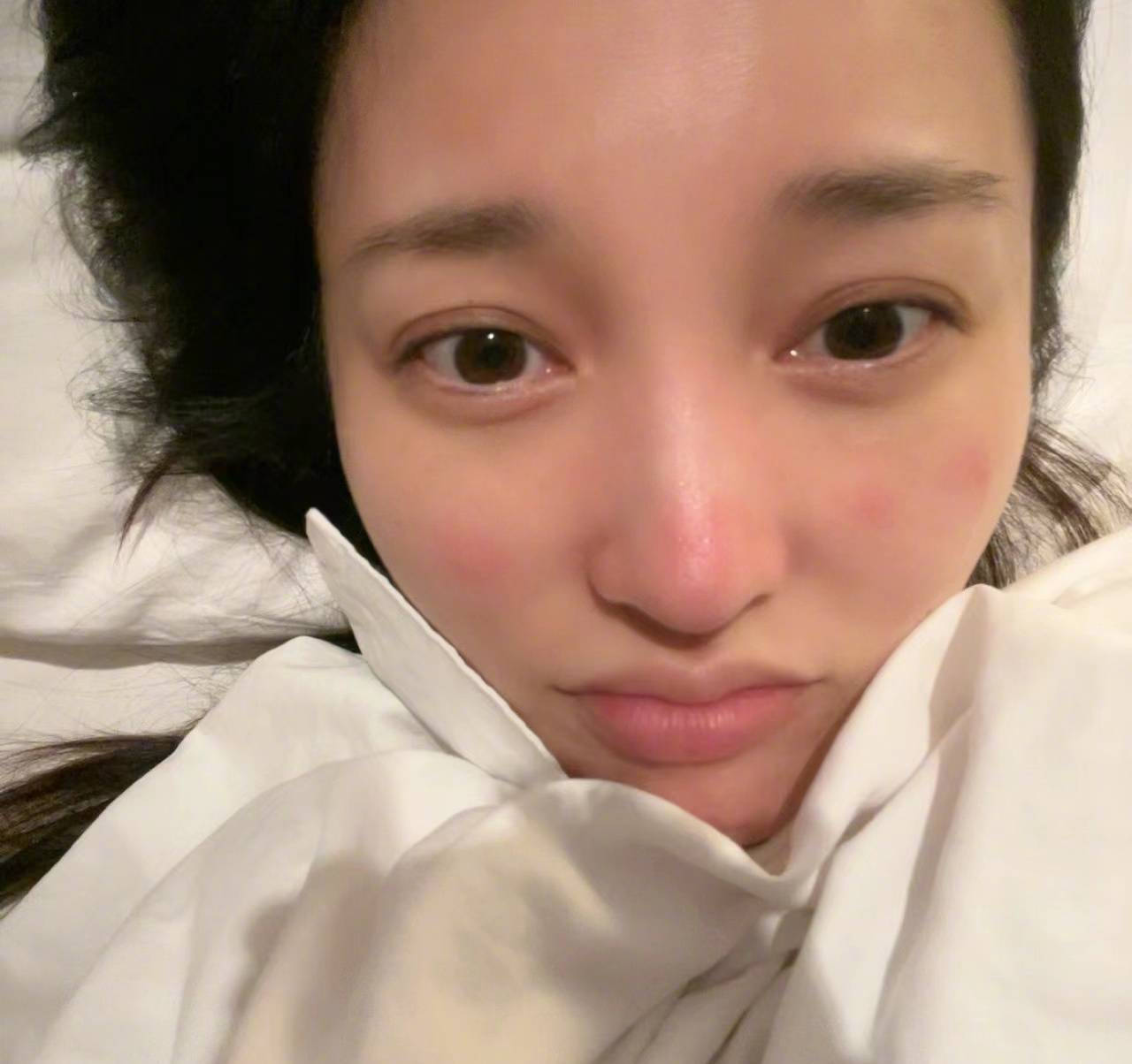 金莎晒居家自拍照过敏的脸蛋让人犯愁