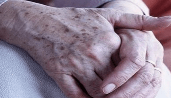 色斑就是比较有代表性的表皮色斑"雀斑"_治疗_黑子_黄褐色