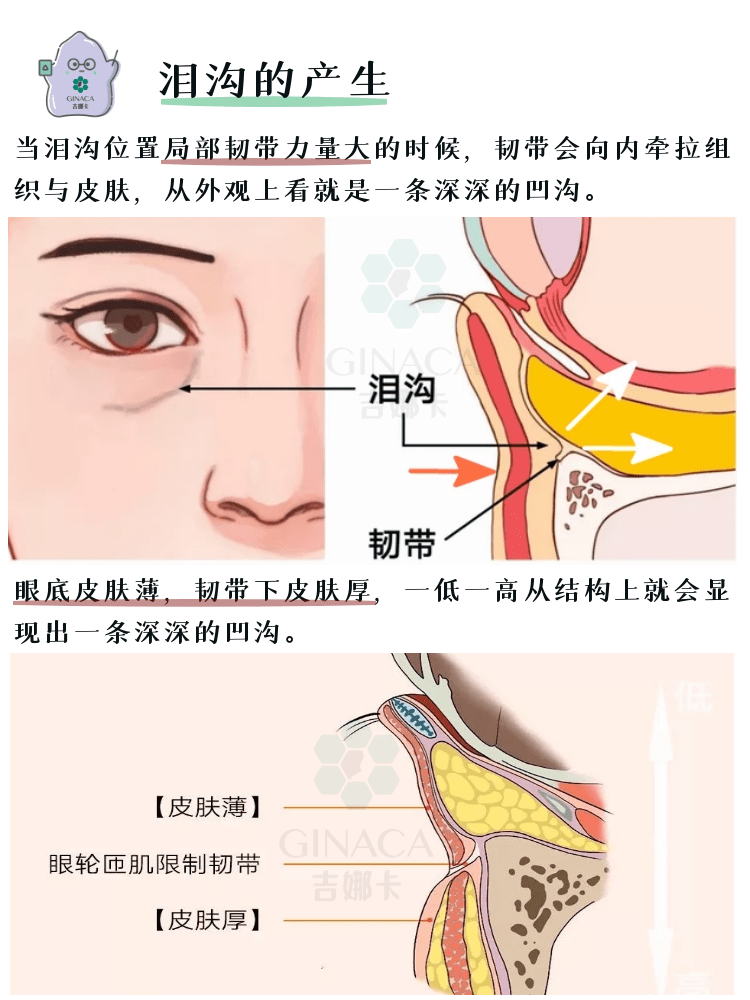 一,泪沟是什么泪沟是指由内眼角开始出现在下眼睑靠鼻侧的一条凹沟