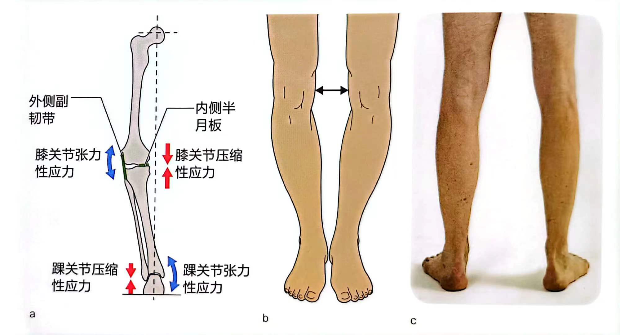 膝外翻,一般也称为x型腿.