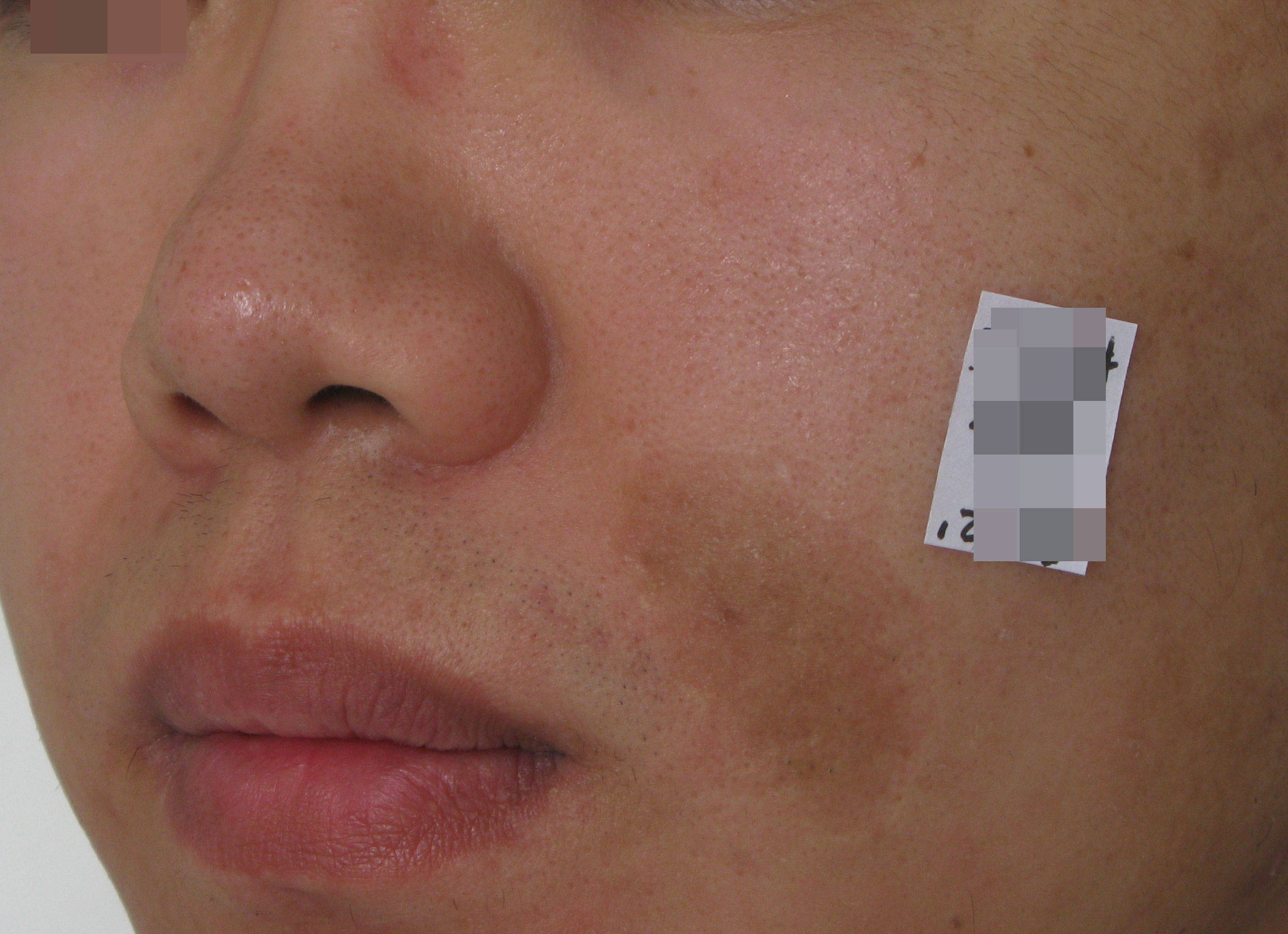 郑州市第二中医院疤痕色素沉着怎么护理