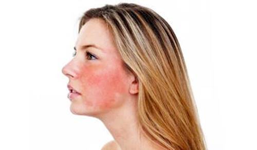皮肤敏感总是满脸爆红该怎么修复？