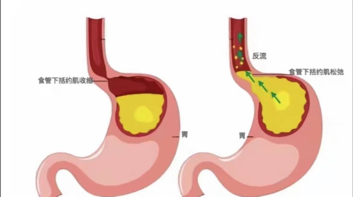 掌握這些方法可望痊癒_食管_胃酸_內容