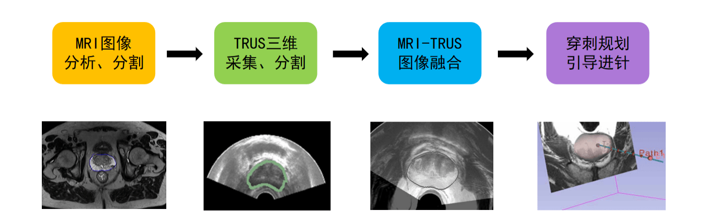 與經直腸超聲(trus)引導下前列腺穿刺活檢相比,mri-trus融合前列腺