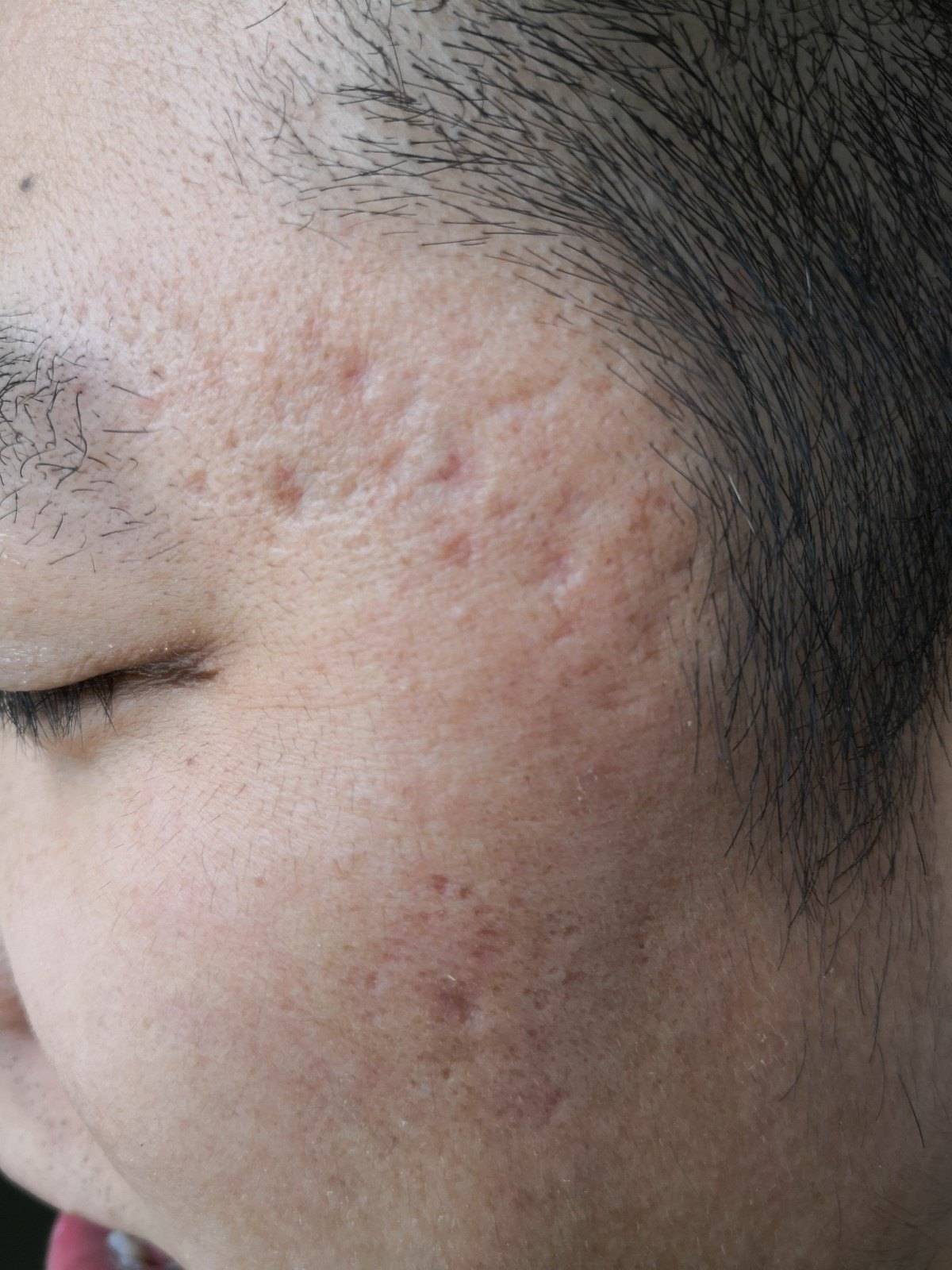 痤疮痘坑可以修复吗?_修护_治疗_效果